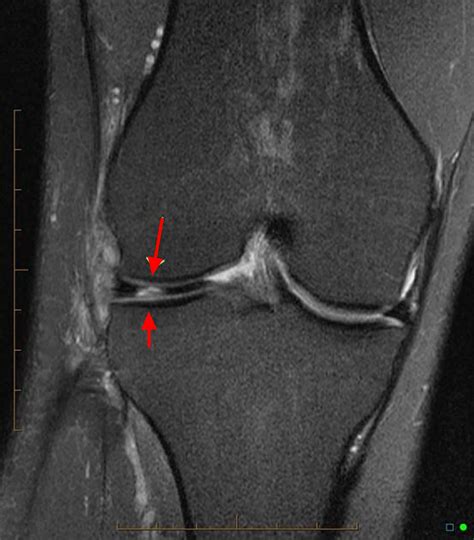 mri test for torn meniscus